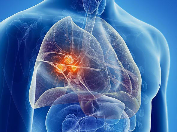Tumori - Quello al polmone rimane il più pericoloso in assoluto