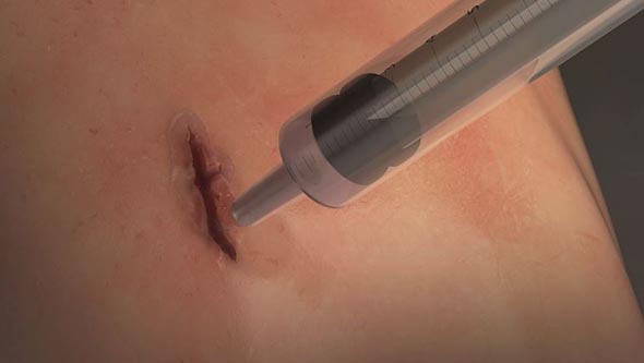 Scienza - Creata la super colla che sostituisce i punti di sutura
